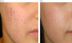 Close-up picture of a face showing laser acne removal.