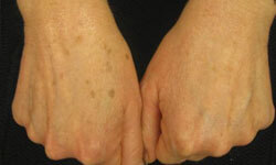 Close-up picture of two hands showing age spots removal.