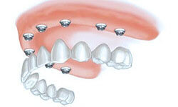 Illustration of an all-on-8 dental procedure.