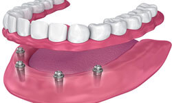 Illustration of an all-on-4 dental procedure.