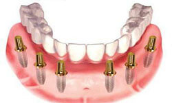 Illustration of an all-on-6 dental procedure.