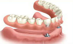 Illustration of an all-on-2 dental procedure.