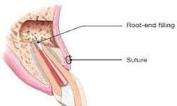 Illustration of an apicoectomy dental procedure.