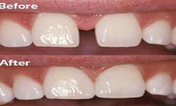 Before and After Illustration of a dental bonding procedure