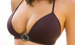 Picture of a woman showing the results of her breast augmentation procedure