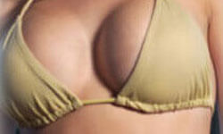 Close-up picture of a woman showing the results of her breast lift with implants procedure