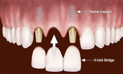 Illustration of the upper teeth showing the placement of a bridge between two implants.