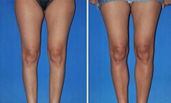 Picture of before and after of a calf implants procedure.