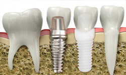 Illustration of a ceramic dental implant next to a zirconium dental implant