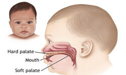 Illustration of cleft lip and palate condition.