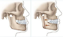 Before and After Illustration of a corrective jaw surgery procedure.