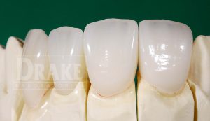 Picture of 5 Emax crowns.