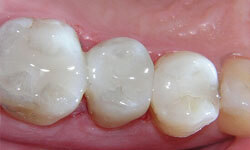 Picture showing 3 white fillings.