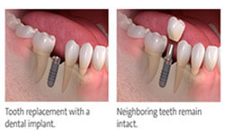 Before and after pictures of the lower jaw showing 6 teeth and the placement of a dental implant crown.