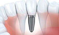 Illustration of several teeth, one of which is a dental implant.