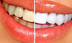 Picture of a smiling woman showing unwhitened teeth on one side of the smile and whitened teeth on the other side.