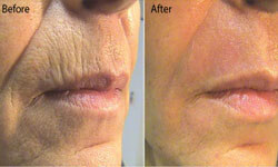 Close-up picture of the upper lips and lower face area showing a Fractional CO2 laser procedure.