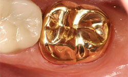 Picture of a gold-filled dental crown.