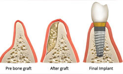 Illustration of three bone graft images.