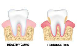 Illustration showing periodontal disease.