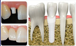 Illustration of a holistic ceramic implant.