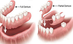 Illustration of holistic full dentures and holistic partial dentures.