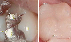 Before and after photos of holistic fillings removal and replacement.