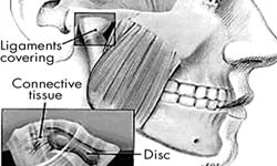 Illustration of the jaw area showing a holistic jaw osteonecrosis condition.