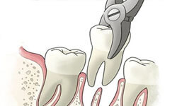 Illustration of a tooth extraction depicting holistic oral surgery.