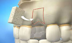 Illustration depicting a holistic plasma and bone graft procedure.