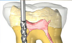 Illustration of a tooth with a drill in the root canal depicting a root canal treatment.