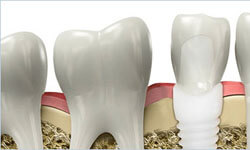 Illustration of a three implants depicting holistic zirconium implants.