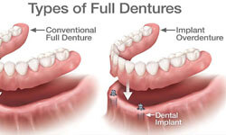 Illustration of a full set of dentures with 4 implants.