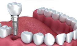 Illustration of the lower set of teeth with one tooth being replaced with a dental implant.