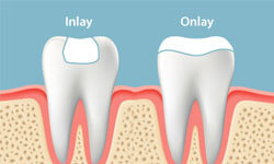Illustration of two teeth, one showing a dental inlay and the other showing a dental onlay.