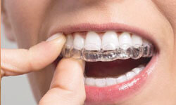 Picture of a dentist holding invisible braces up to a patient’s teeth.