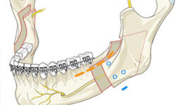 Illustration of a corrective jaw surgery procedure.