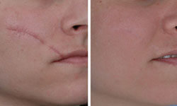 Close-up picture of a face showing a laser scar removal procedure.