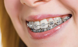 Picture of a dental patient showing metal braces on her teeth.