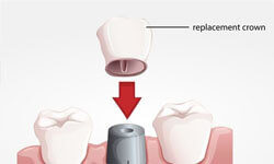 Illustration of how a crown fits on a reshaped tooth.