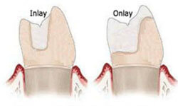 Illustration of three teeth, one showing a crown, but the other two showing a dental inlay and a dental onlay