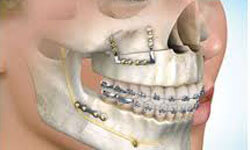 Illustration of a face and skull showing the components of an oral and maxillofacial procedure.