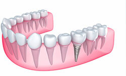 Illustration of the lower teeth showing a dental implant placed after oral surgery.