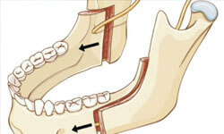 Illustration of the lower jaw showing the approach for orthognathic surgery.