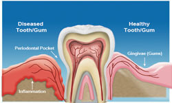 Illustration of a tooth placed in the gum and showing inflammation in the surrounding areas.