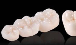 Picture of 4 pure porcelain Emax dental crowns.