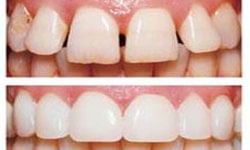 Picture of upper and lower teeth showing before and after having a pure porcelain veneers procedure.