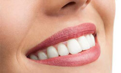 Picture of a smiling woman showing her pure porcelain zirconium emax crowns procedure.