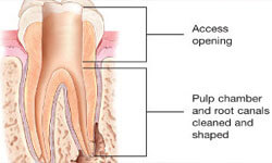 Illustration of a tooth showing the access for a root canal and how it is done.