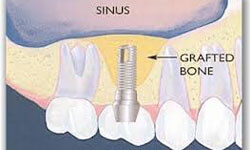 Illustration of a sinus lift showing bone grafts to the sinus area.
